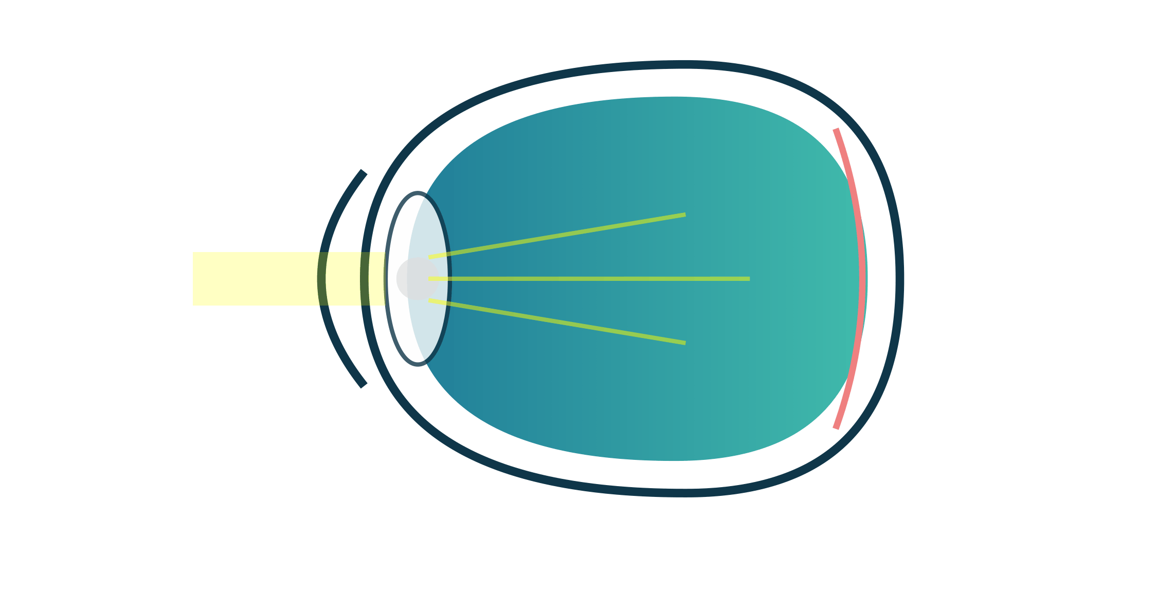 Fast-Track Cataract